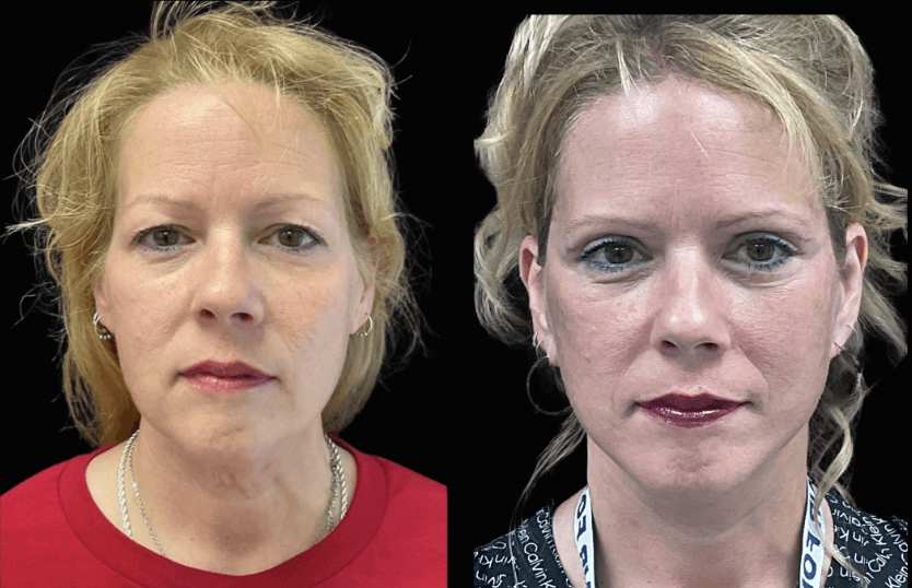 Facelift before and after, patient 1