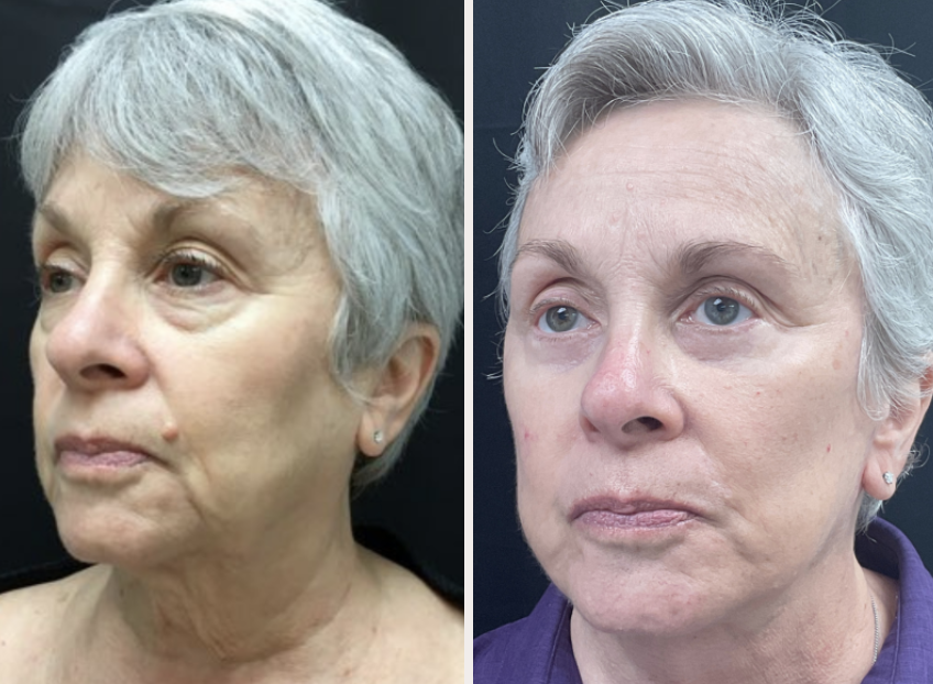 Facelift before and after, patient 2