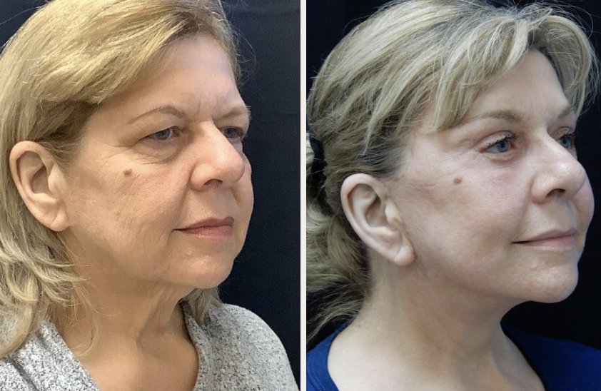 Facelift before and after, patient 3